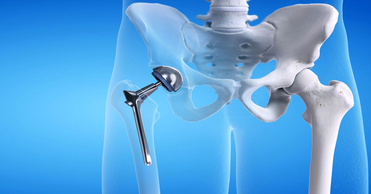 Kalça Artroplastisi Nedir?