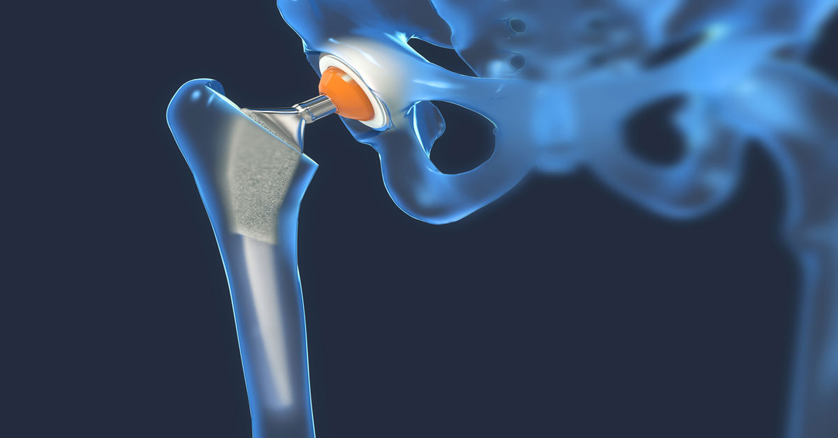 Kalça Artroplastisi Nedir?