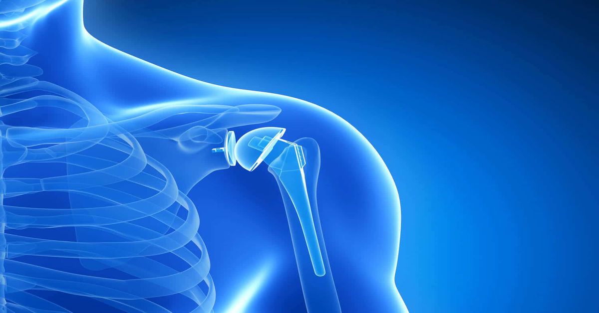 Omuz Artroplastisi Nedir? Omuz Artroplastisi Nedir?