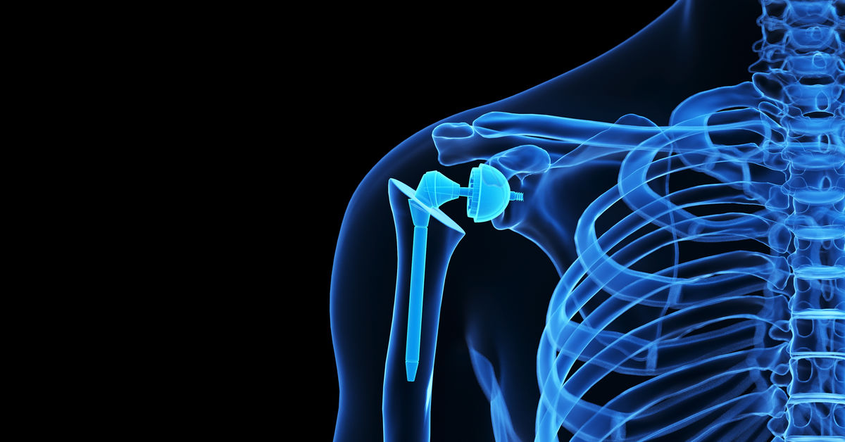 Omuz Artroplastisi Nedir? Omuz Artroplastisi Nedir?